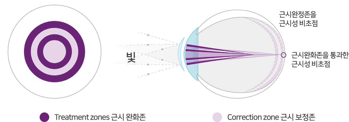 Treatment zones 근시 완화존  Correction zone 근시 보정존 